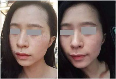 淡斑专业榜单祛斑效果最好的第一OG真人平台2024十大内推(图5)