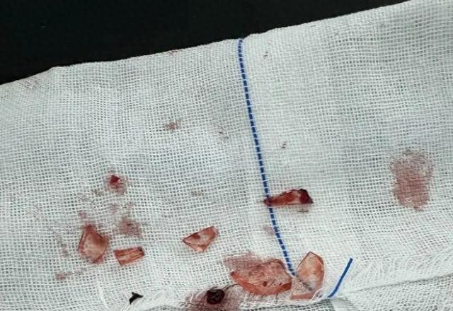 爆炸造成男孩全脸约30处伤OG真人手中“玩具”突然(图3)